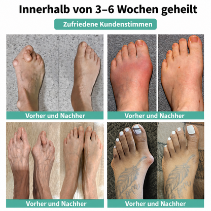 🏅 Natravor® Patch botanique confort pour hallux valgus 👠 Soin des pieds flexible + formule de confort d’inspiration végétale