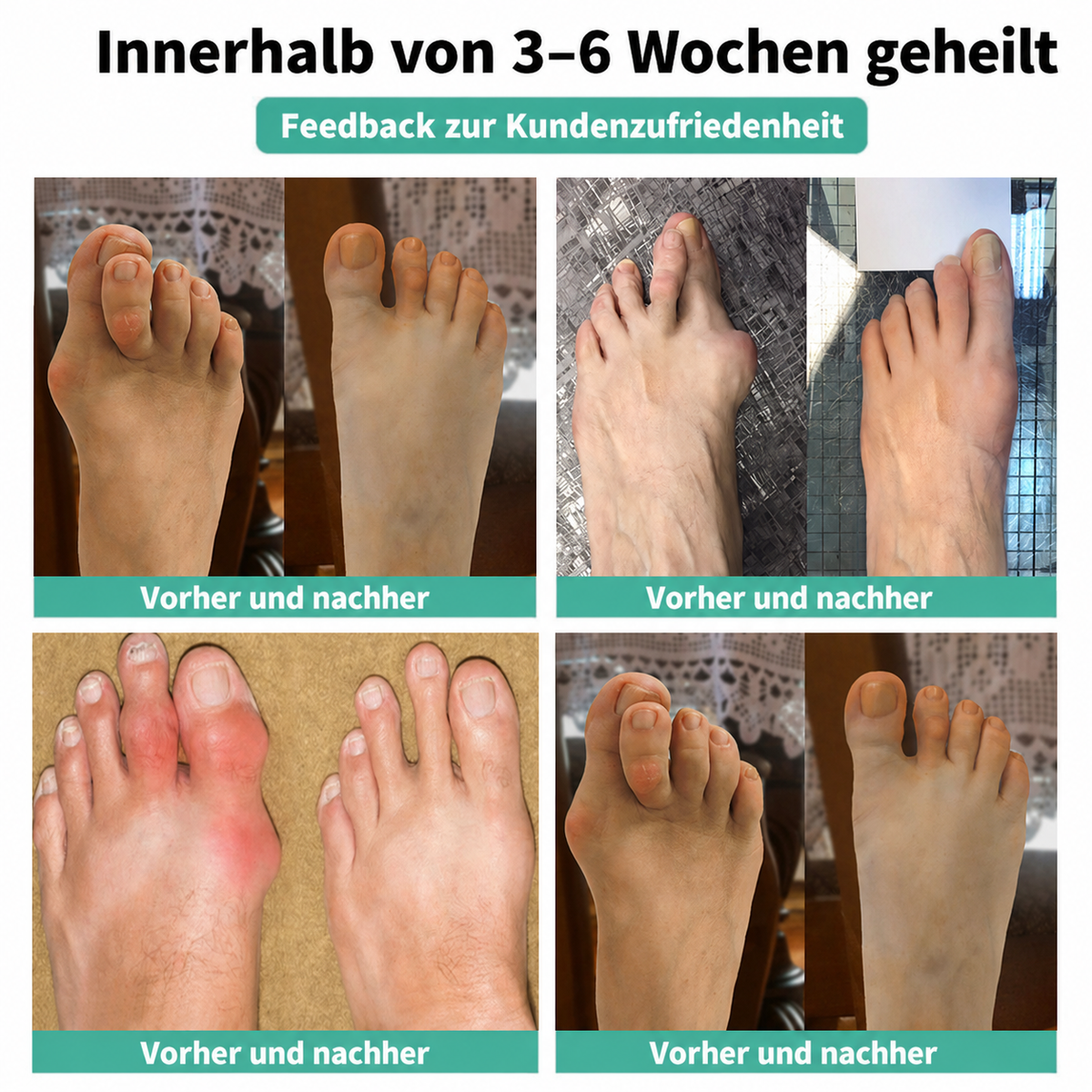 🏅 Natravor® Patch botanique confort pour hallux valgus 👠 Soin des pieds flexible + formule de confort d’inspiration végétale